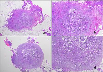 Use of Laparoscopic and Laparotomic J-Plasma Handpiece in Gynecological Malignancies: Results From A Pilot Study in A Tertiary Care Center